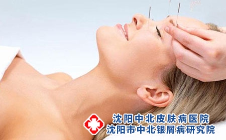 2 (234)頭發(fā) 針灸