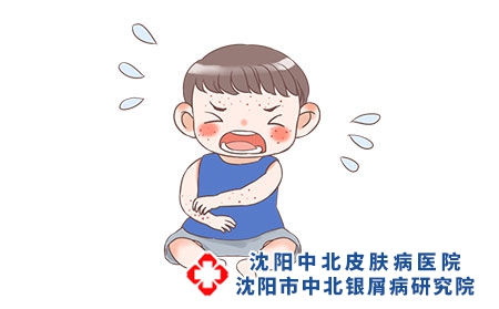 攝圖網(wǎng)_401762381_兒童濕疹（企業(yè)商用）