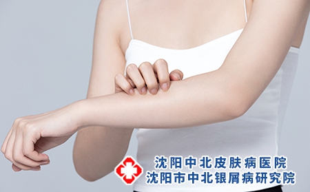 攝圖網(wǎng)_501700721_皮膚過敏抓撓手臂的女性（企業(yè)商用）