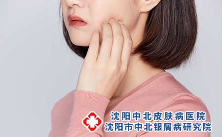 攝圖網(wǎng)_501684066_女性被蚊蟲叮咬抓臉頰牙疼（企業(yè)商用）