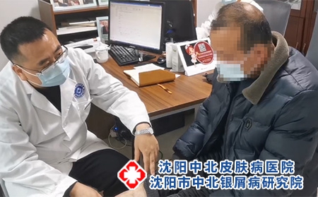 沈陽(yáng)哪里看銀屑病-沈陽(yáng)市中北銀屑病研究院-沈陽(yáng)哪家專治銀屑病