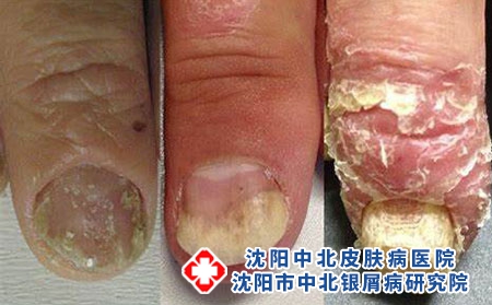 指甲牛皮癬2 指甲牛皮癬2