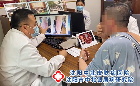 沈陽哪治銀屑病好-沈陽中北銀屑病研究院-沈陽治療銀屑病去哪
