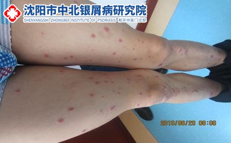 到沈陽(yáng)看牛皮癬哪家醫(yī)院比較好