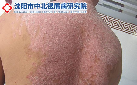 沈陽(yáng)看的好銀屑病的醫(yī)院